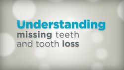 Understanding missing teeth and tooth loss