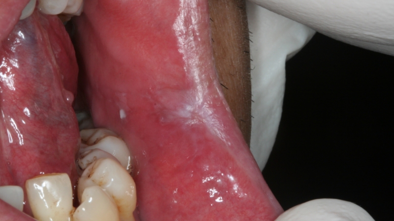 Oral Candidiasis: Diagnosis & Treatment | Spear Education
