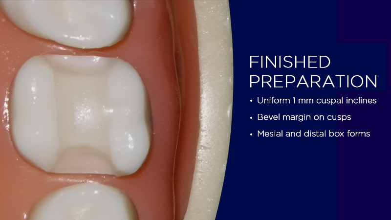 Preparing an Upper Molar for a Direct or Indirect Onlay | Spear Education