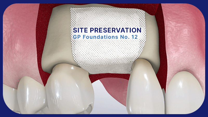 Simple Ridge Preservation — GP Foundations No. 12 | Spear Education