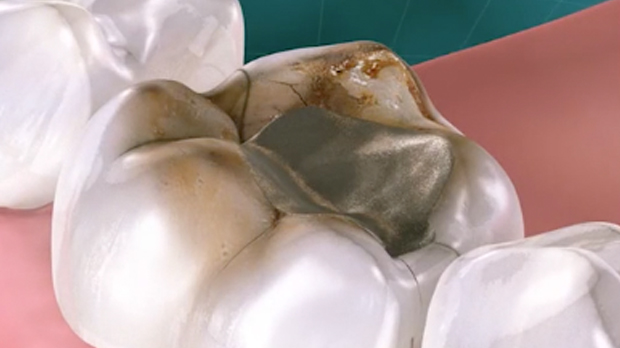 Patient Communication in Single-Tooth Cases | Spear Education