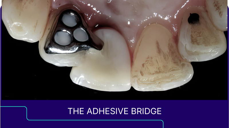 The Adhesive Bridge | Spear Education