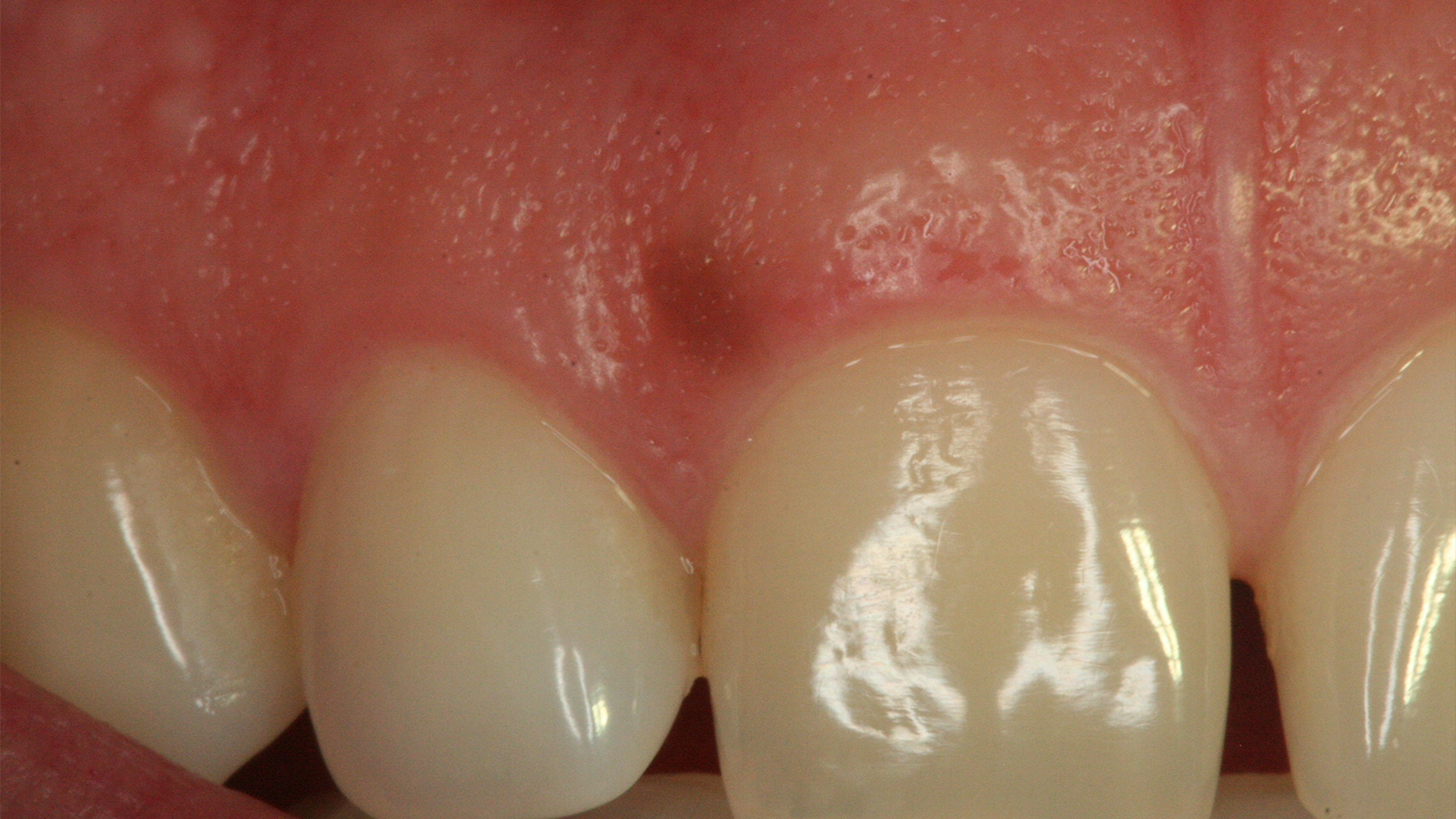 Benign Oral Pigmented Lesions | Spear Education