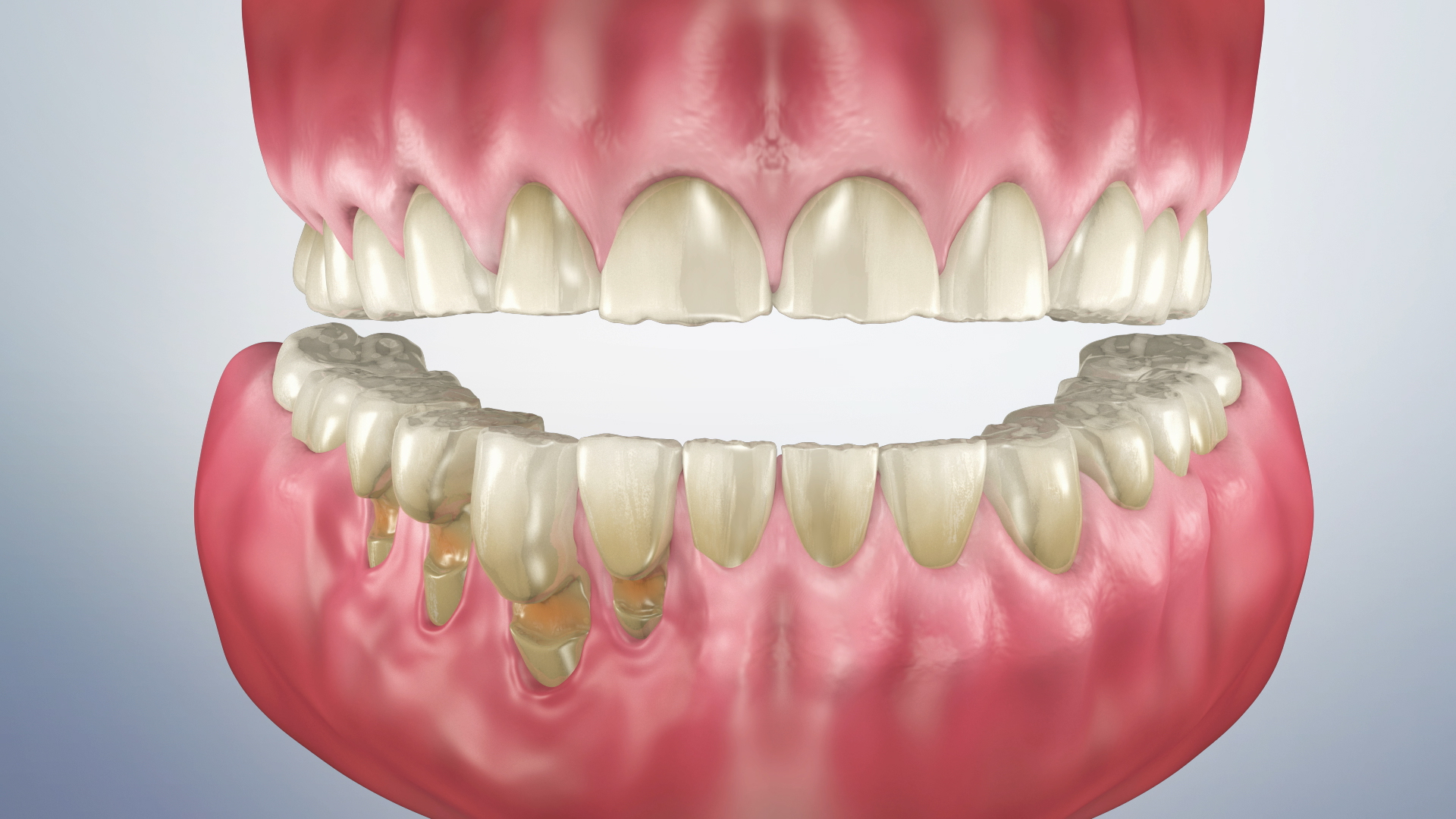 Thumbnail for a video on Understanding Tooth Wear