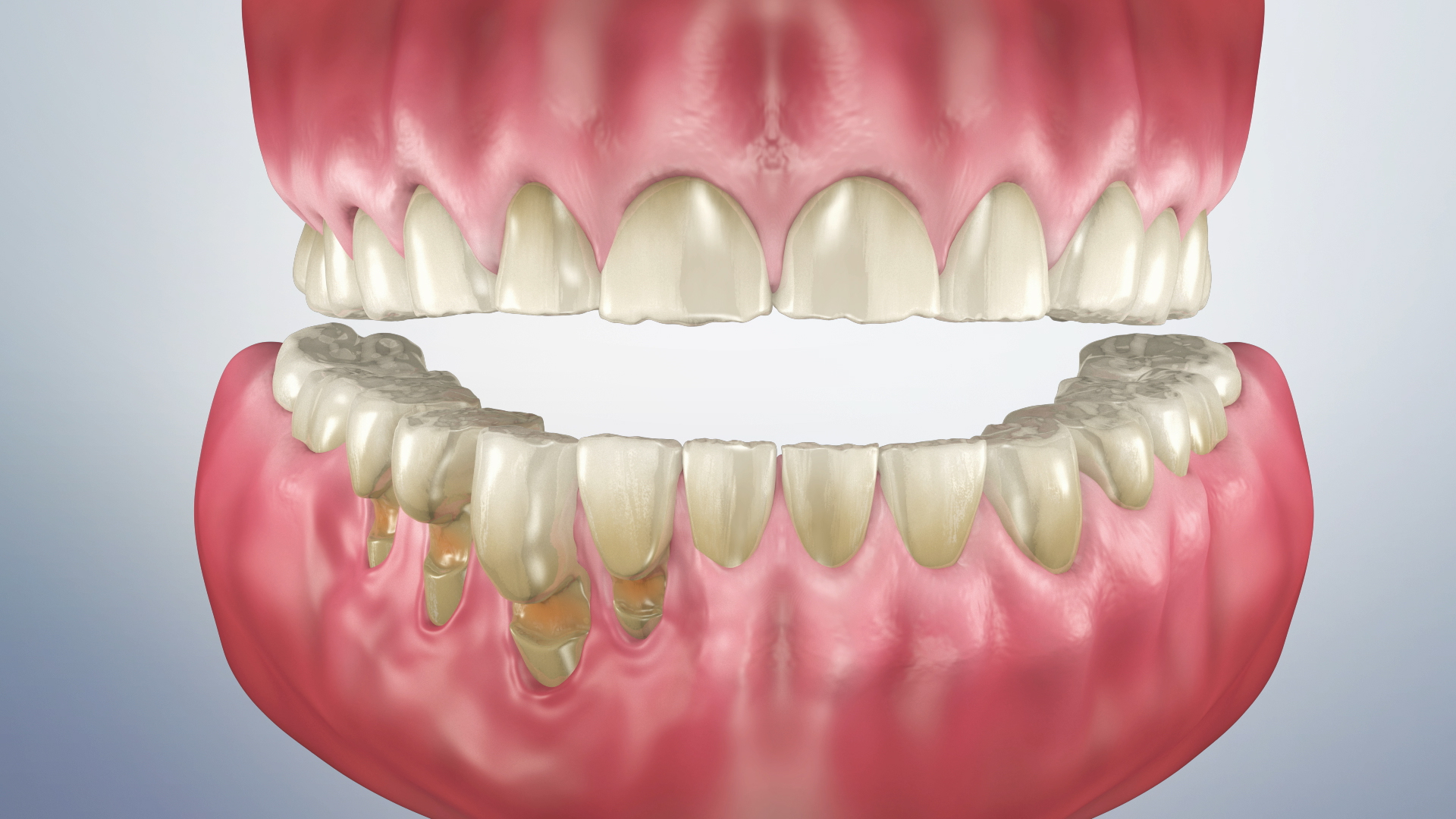 What Is Pocket Depth Of A Tooth