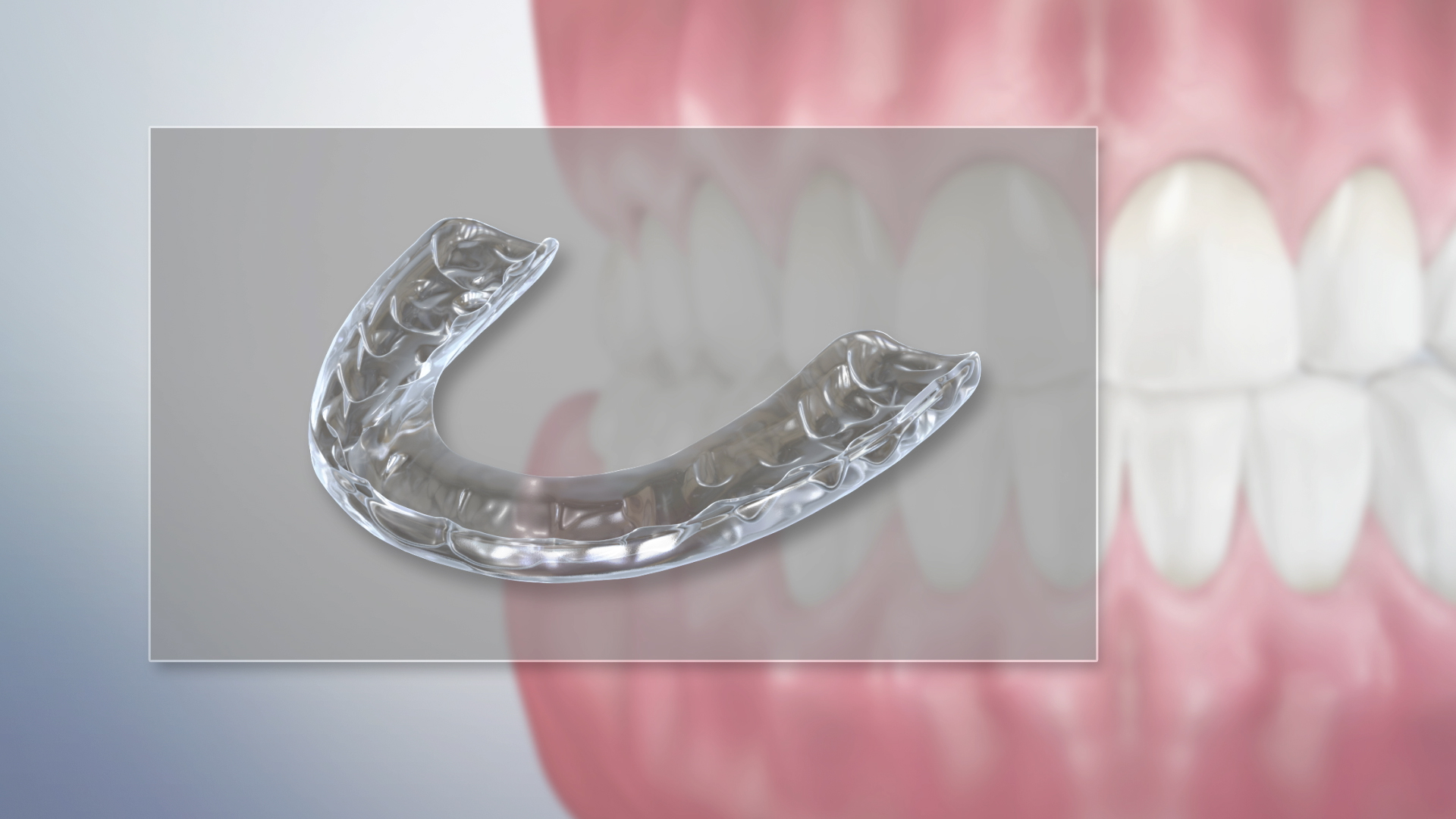 Thumbnail for a video on Occlusal Appliance for Tooth Wear