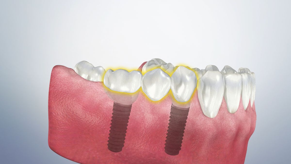 Caring for a Bridge (Implant Supported) | Crown Pointe Dentistry