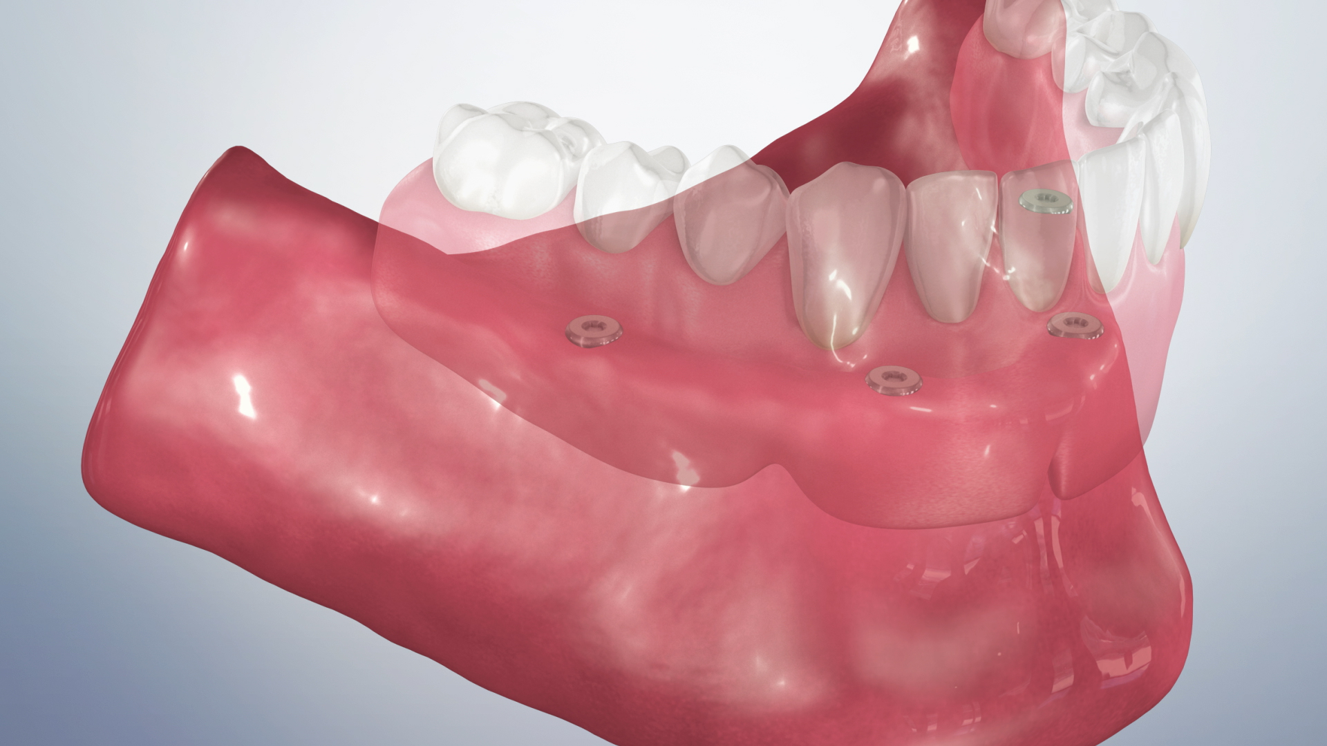 Thumbnail for a video on Post-Operative Instructions for a Bar-Retained Overdenture